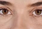 PÁRPADOS CAÍDOS Y BOLSAS: CÓMO FUNCIONA LA BLEFAROPLASTIA CON LÁSER HÍBRIDO