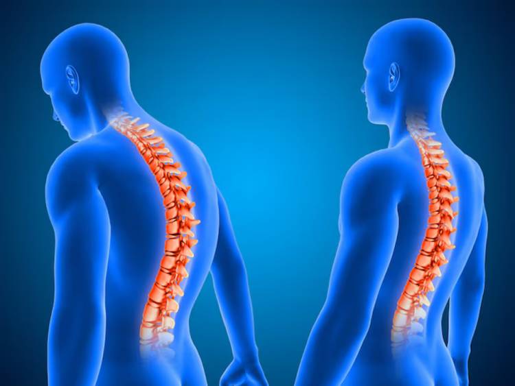 ESCOLIOSIS: EL DEPORTE Y LOS CHEQUEOS COMO PILARES DEL DESARROLLO SALUDABLE DE NIÑOS Y ADOLESCENTES